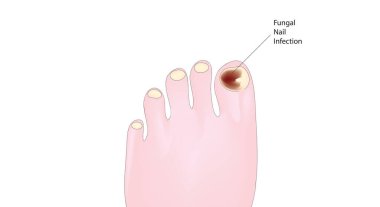 Tırnak mantar enfeksiyonu illüstrasyon
