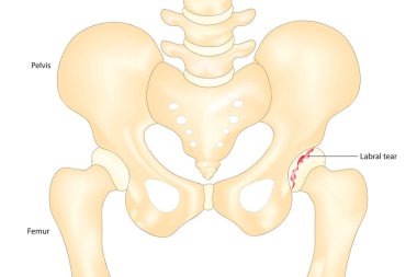 Hip labral yırtık diyagramı