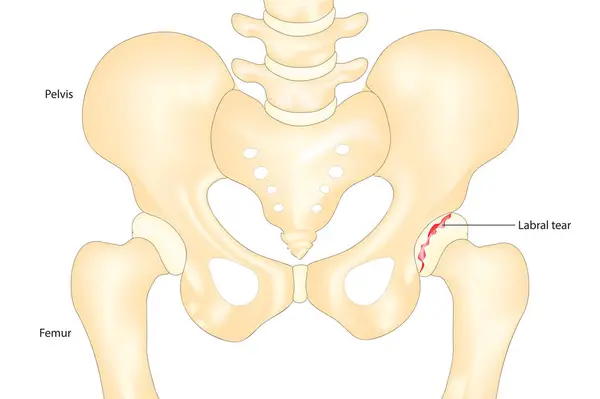 Hip labral yırtık diyagramı