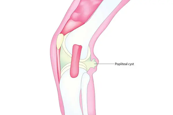 Dizinin içindeki Popliteal kist.