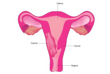 Kadın üreme sisteminde kanser artışı