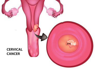 Biological illustration of Cervical cancer clipart