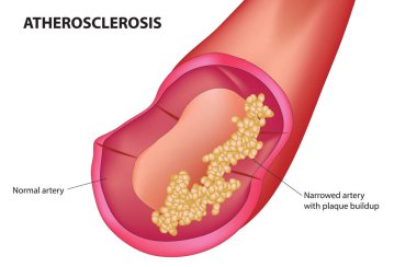 Atherosclerosis anatomi diyagramı yapısı