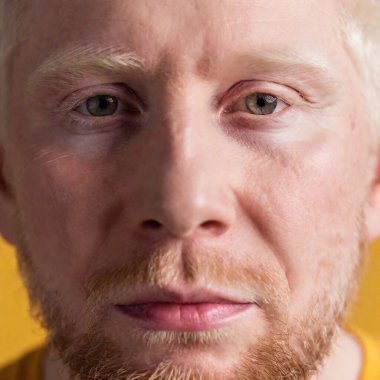 close-up portrait of male face with Albinism. full frame image.  clipart