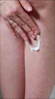 Tüyleri alındıktan sonra cilde krem sürerken yakın plan. Elektroliz sonrası iltihaplı bacak derisine beyaz krem süren bir kadının yakın çekimi. Kırmızı şişlikler, kısmi saç ve deri dokusu görünür..