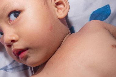 Bebek göğüs derisi tahrişi. Çocuklar için iyi olmayan sıcak ve yiyeceklerden dolayı bebek göğsünde tahriş var..