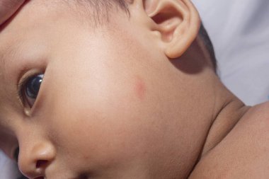 Bir bebeğin boynundaki kırmızı deri ve yanaklarındaki kaşıntı, tahriş ve dikenli ısıdan kaynaklanır. Sabun, şampuan ve cilt nemlendiricisinden dolayı tahriş. Bebeklerin cilt sağlığı kavramı.