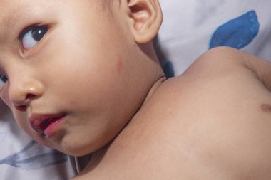 Bir bebeğin boynundaki kırmızı deri ve yanaklarındaki kaşıntı, tahriş ve dikenli ısıdan kaynaklanır. Sabun, şampuan ve cilt nemlendiricisinden dolayı tahriş. Bebeklerin cilt sağlığı kavramı.