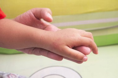 Çocuk atopik dermatitten etkilenen deriyi tırmalıyor. Çocuk, atopik dermatitten, diyatezden, çocuğun vücudundaki alerjilerden etkilenen cilde özel krem sürer..