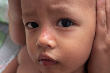 Bir bebeğin boynundaki kırmızı deri ve yanaklarındaki kaşıntı, tahriş ve dikenli ısıdan kaynaklanır. Sabun, şampuan ve cilt nemlendiricisinden dolayı tahriş. Bebeklerin cilt sağlığı kavramı.