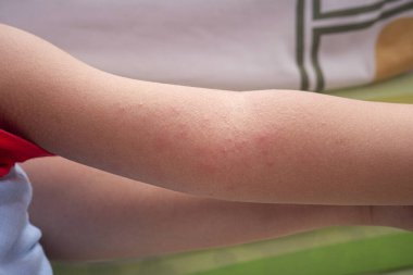 Çocuk atopik dermatitten etkilenen deriyi tırmalıyor. Çocuk, atopik dermatitten, diyatezden, çocuğun vücudundaki alerjilerden etkilenen cilde özel krem sürer..