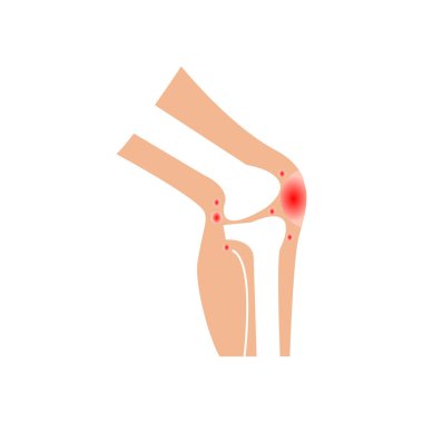 Diz Eklem Ağrısı Tıbbi Vektör İllüstrasyonu Kırmızı İltihaplanma Vurgusu