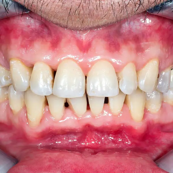 Ağzı açık gülümseyen, parlak beyaz dişlerini gösteren bir kişinin yakın plan fotoğrafı..