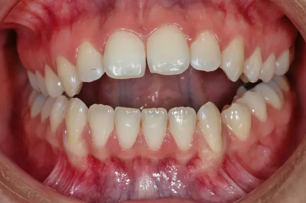 Kişinin dişlerinin yakın plan görüntüsü. Dişler görünür durumda ve iyi durumda görünüyor. Diş etleri de görülebilir ve sağlıklı görünüyor..