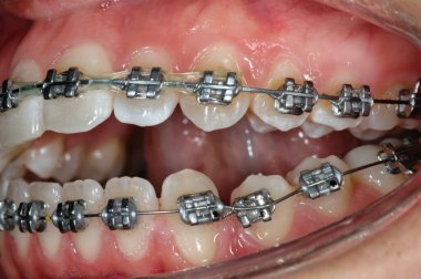 Üst ve alt dişlerinde diş telleri olan, ağzı hafif açık insanların yakın plan görüntüsü..