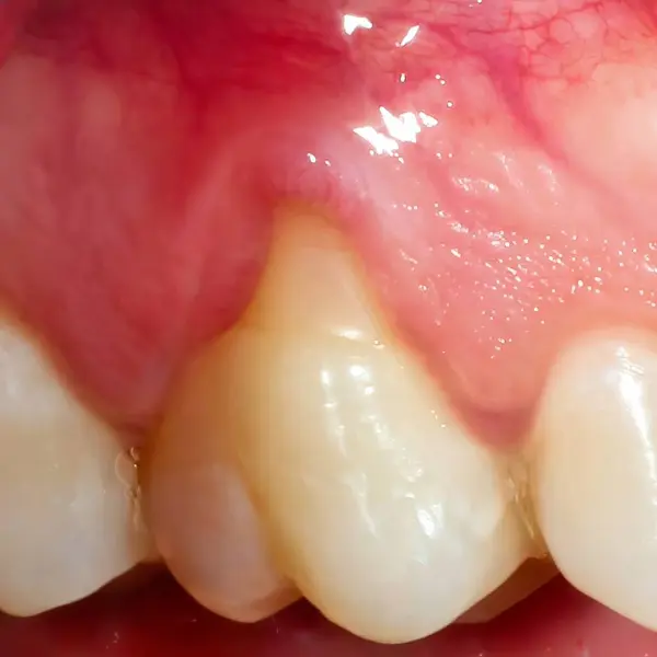 Diş ameliyatından sonra diş etlerinin yakın plan görüntüsü kanama ve hafif şişkinlik gösteriyor..