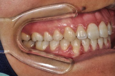 Kişinin dişlerinin bir kenar görüntüsü, dişlerinin dizilişini ve durumunu gösteren bir retraktör yerleştirilmiş..