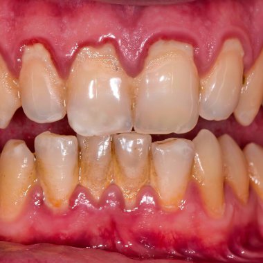 Ön dişlerde sakız durgunluğunu gösteren yakın plan görüntüler. Diş etleri kırmızı ve iltihaplı..