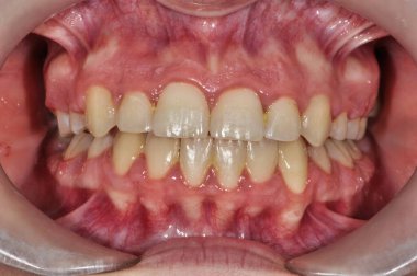 Yetişkinlerin dişlerinin ve diş etlerinin doğal rengini ve hizasını gösteren yakın plan bir görüntüsü..