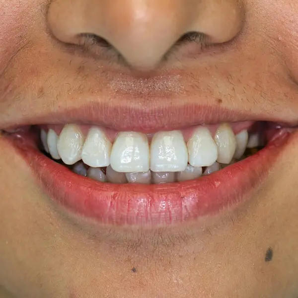 Yakın plan bir görüntüde diş etleri çekiliyor ve diş kökleri ortaya çıkıyor..