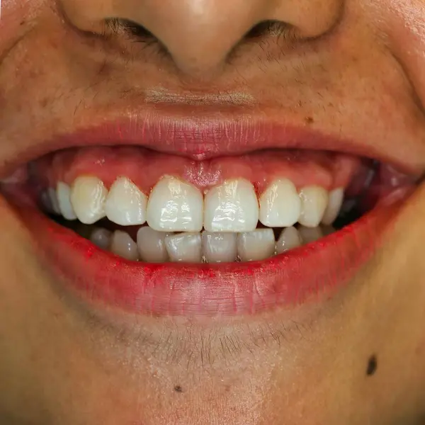 Diş etlerinin çekildiği, diş köklerinin ortaya çıktığı yakın plan bir görüntü. Görüntü, sakız hastalığı potansiyelini ve ağız sağlığı üzerindeki etkisini vurguluyor..