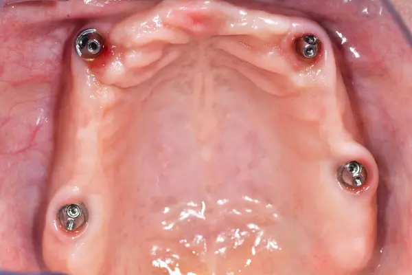 Yakın plan görüntü ameliyattan sonra üst çeneye yerleştirilen dört diş implantını gösteriyor.