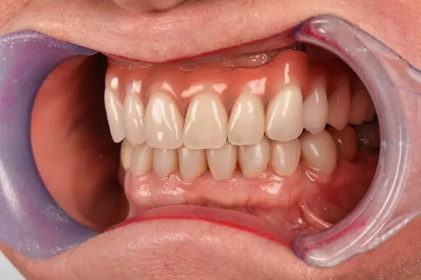 Takma dişlerini sergileyen birinin yakın plan fotoğrafı. Görüntü yeni, sağlıklı dişleri ön plana çıkarıyor..