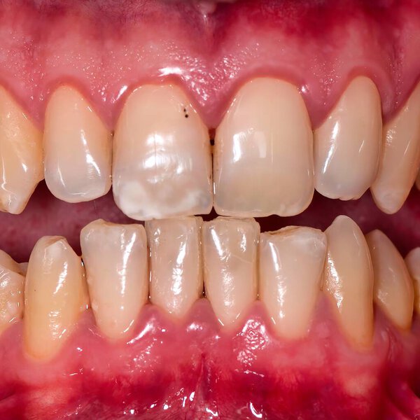 Крупный план рецессии десен на одном зубе.