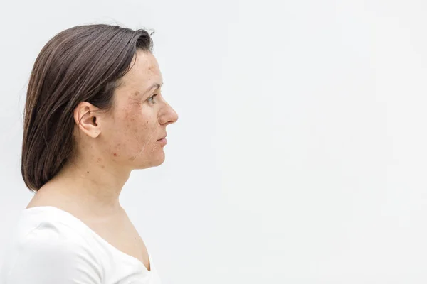 Photo of side view of woman with damaged skin. Concept of skin care.