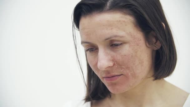 Zwolnione Tempo Przycięte Wideo Kobiety Złą Skórą Pojęcie Pielęgnacji Skóry — Wideo stockowe