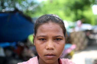 NEW DELHI INDIA JULY 24 2023 Flood affected people living in temporary tent sites are suffering with Eye Flu at Vikas Marg ITO on July 24 2023 in New Delhi India Photo by Salman Ali Hindustan Times clipart