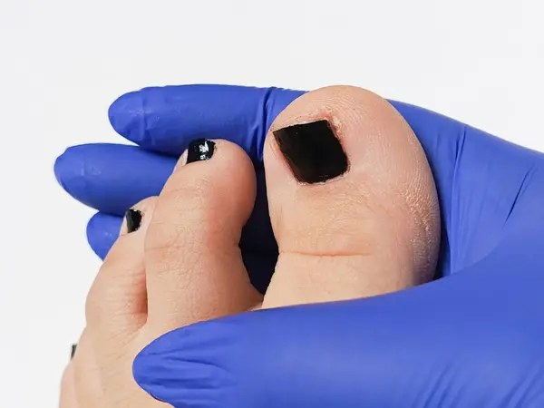 Podiyatrist ayak parmaklarının tırnaklarını inceliyor. Tırnak mantarı tedavisi. Ayak hastalıkları uzmanı. Ayak tedavisi.