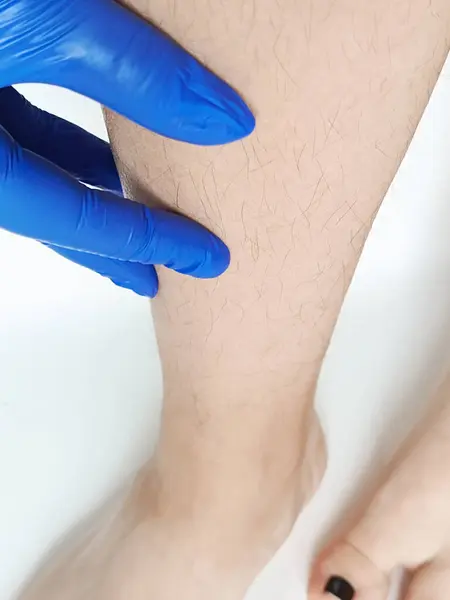 Tıbbi eldivenli bir el bacaklarındaki saçlara dokunuyor. Lazer tüy aldırma. Elektroepilasyon. Saç kökleri..