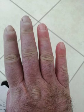 Reynaud sendromlu skleroderma hastası el..