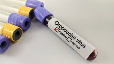 Blood sample of patient positive test for Oropouche virus.  medical and health concept clipart