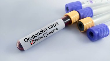 Oropouche virüsü için hastanın kan örneği pozitif çıktı. tıbbi ve sağlık konsepti