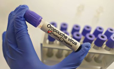 Oropouche virüsü için hastanın kan örneği pozitif çıktı. tıbbi ve sağlık konsepti