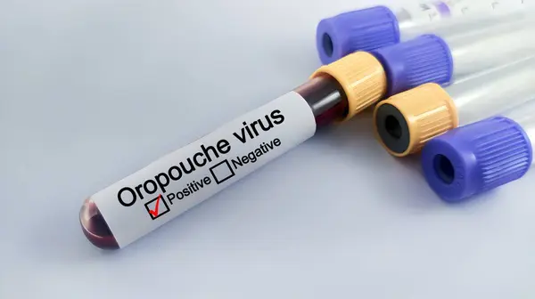 stock image Blood sample of patient positive test for Oropouche virus.  medical and health concept