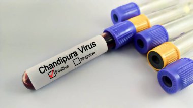 Blood sample of patient positive test for Chandipura virus. clipart