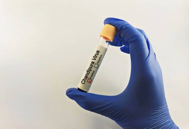 Blood sample of patient positive test for Chandipura virus. clipart