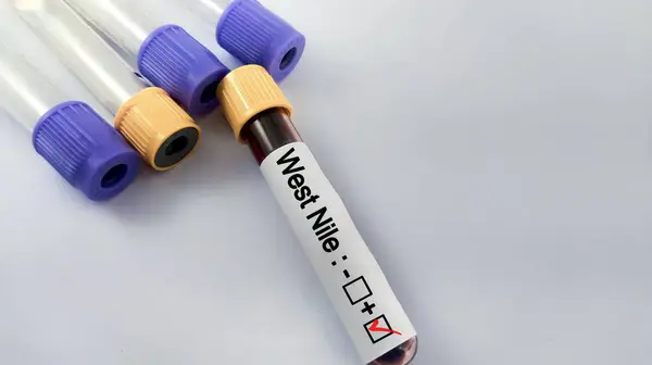 stock image West Nile positive blood sample. Blood sample for West Nile virus testing