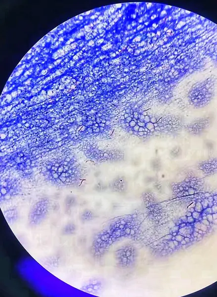 stock image Microscopic morphology of Ziehl-Neelson staining of Mycobacterium species.