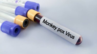 Maymun Çiçeği virüsü testi için kan örneği tüpü. Maymun çiçeği salgını. Maymun çiçeği enfekte kan örneği.