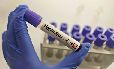 Hantavirüs 'ü tutan bilim adamı test tüplerindeki kanı enfekte etti.