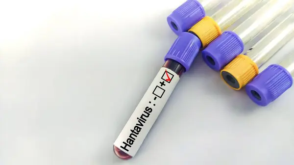 stock image Blood sample of patient positive test for Hantavirus.