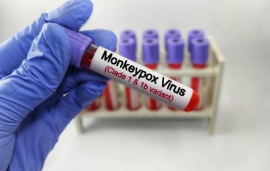 Maymun çiçeği virüsü (MPXV) testi için kan testi. Mpox (Maymun Çiçeği olarak da bilinir), Maymun Çiçeği virüsü olarak bilinen virüsün yol açtığı bir hastalıktır. zoonotik hastalıklar.