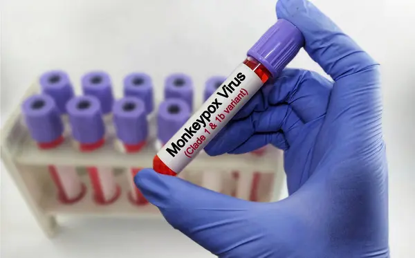 stock image Blood test sample for monkey pox virus (MPXV) test. Mpox (formerly known as monkeypox) is a disease caused by infection with a virus, known as Monkeypox virus. zoonotic disease.