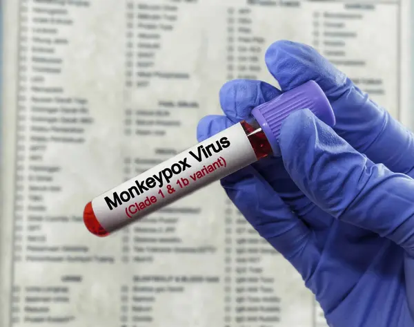 stock image Blood test sample for monkey pox virus (MPXV) test. Mpox (formerly known as monkeypox) is a disease caused by infection with a virus, known as Monkeypox virus. zoonotic disease.