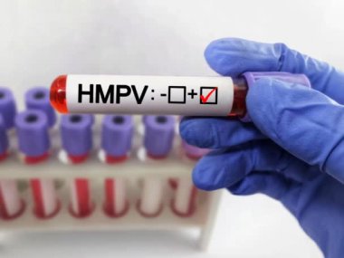 İnsan Metapneumovirüsü (HMPV) pozitif test, Tıbbi Sağlık Konsepti