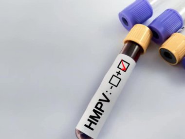 İnsan Metapneumovirüsü (HMPV) pozitif test, Tıbbi Sağlık Konsepti